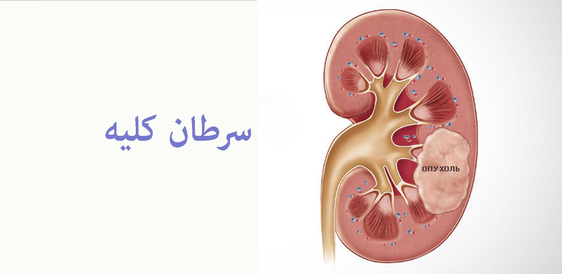 چه عواملی سبب ایجاد سرطان کلیه می شود؟